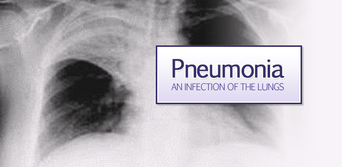 Pneumonia Can Be Prevented - Vaccines Can Help 